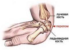 Перелом кости запястья