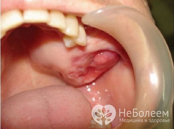 Амелобластома – одна из самых распространенных опухолей в хирургической стоматологии