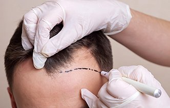 Пересадка волос: современный путь к восстановлению густоты