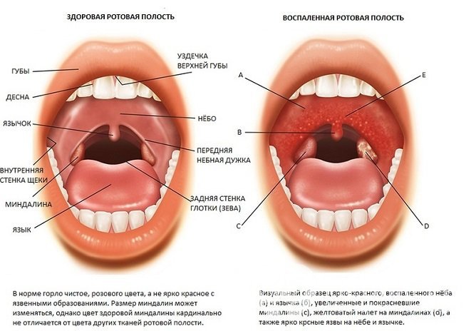 При тонзиллите поражаются небные миндалины, в процесс могут вовлекаться окружающие ткани