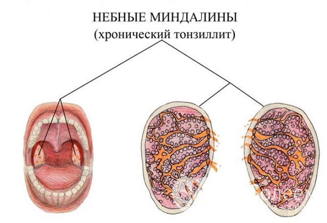 Патология характеризуется нарушением защитных функций небных миндалин