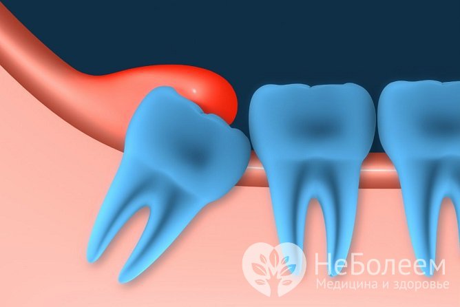 Прорезывание зуба мудрости может быть болезненным и сопровождаться отеком десны из-за неправильного расположения зуба