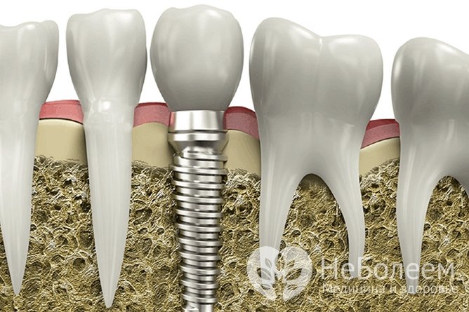 Какие импланты лучше ставить на передние зубы?