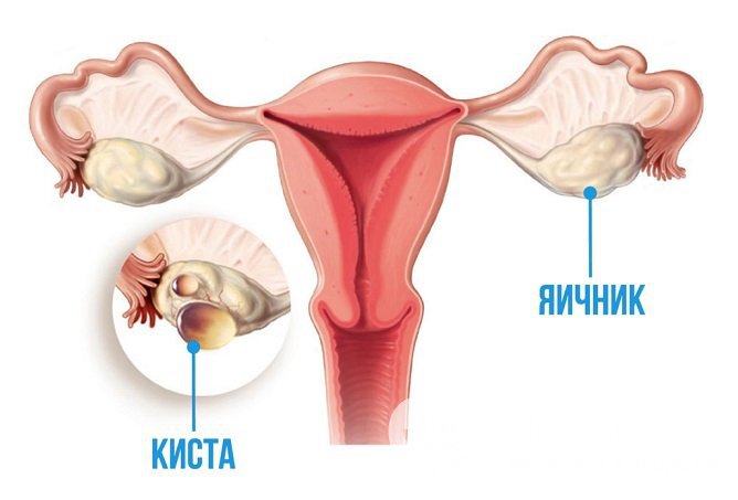 Киста правого яичника