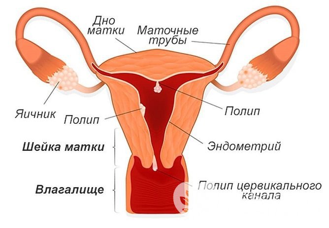 Полип цервикального канала: причины появления, симптомы, лечение