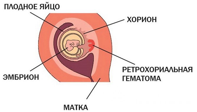 Ретрохориальная гематома при беременности на ранних сроках: причины, симптомы, лечение