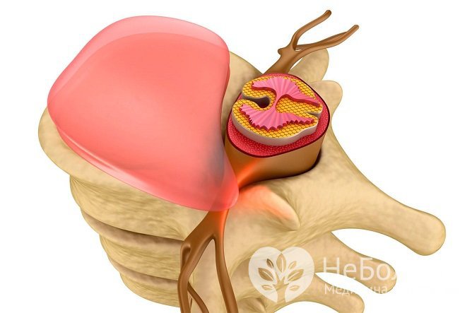 При грыже шейного отдела позвоночника сдавливаются нервные корешки из-за смещения диска